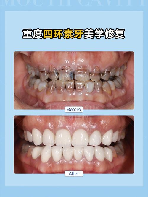 四环素牙齿美白方法有哪些?不同方法的效果如何,是否存在风险,又该如何科学选择?-图1 四环素牙齿美白方法有哪些?不同方法的效果如何,是否存在风险,又该如何科学选择?-图1