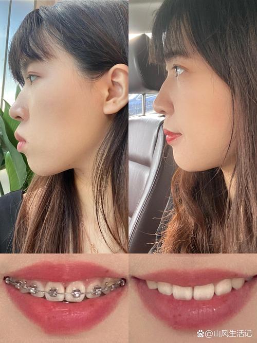 正畸牙齿矫正真的能让鼻梁变高吗？背后的原因、真实效果及科学依据是什么？-图1