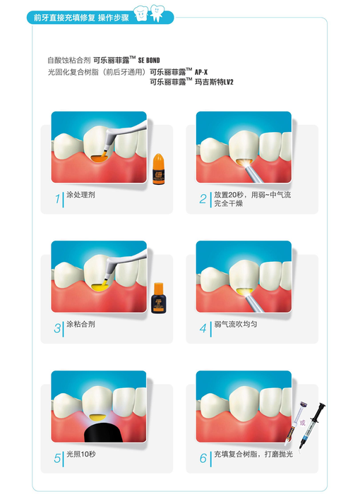 树脂充填器的正确使用方法具体包括哪些步骤？操作时需注意哪些细节以避免常见问题？-图1