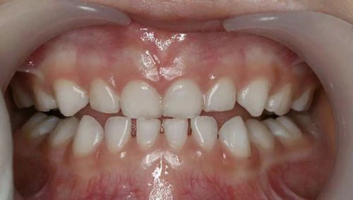 儿童正畸后牙齿变色是什么原因导致的?会影响牙齿健康吗?该如何有效处理和预防?-图1 儿童正畸后牙齿变色是什么原因导致的?会影响牙齿健康吗?该如何有效处理和预防?-图1