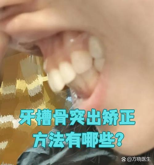 牙槽骨突出手术方法有哪些?不同术式的适应症、优缺点、术后恢复期及风险因素如何科学选择与评估?-图2 牙槽骨突出手术方法有哪些?不同术式的适应症、优缺点、术后恢复期及风险因素如何科学选择与评估?-图2