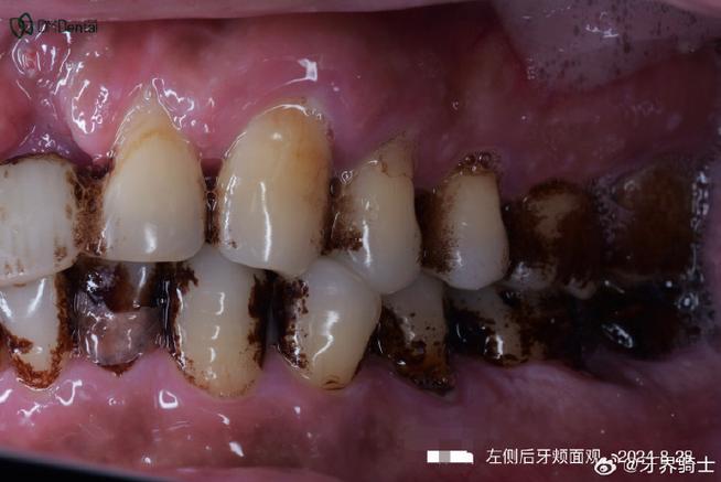 正畸托槽边缘变黑是正常现象吗?背后可能隐藏哪些口腔问题?如何有效处理并避免复发?-图3 正畸托槽边缘变黑是正常现象吗?背后可能隐藏哪些口腔问题?如何有效处理并避免复发?-图3