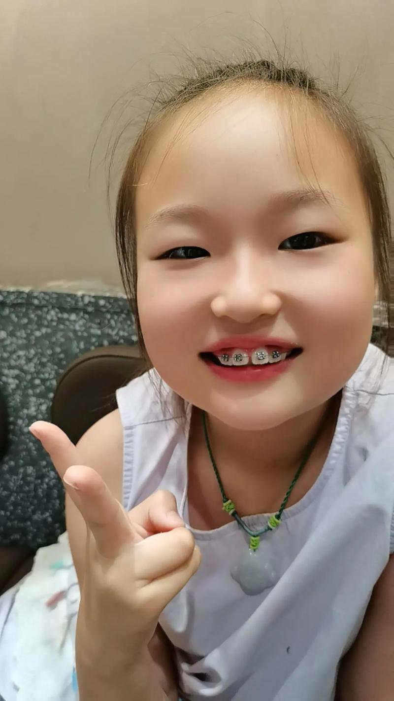 正畸托槽边缘变黑是正常现象吗?背后可能隐藏哪些口腔问题?如何有效处理并避免复发?-图1 正畸托槽边缘变黑是正常现象吗?背后可能隐藏哪些口腔问题?如何有效处理并避免复发?-图1