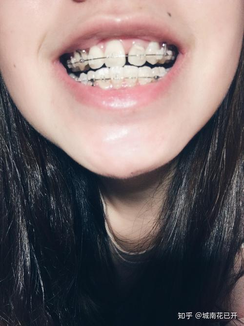 20岁正畸牙齿矫正周期一般是多久？不同牙齿畸形程度会影响治疗时间吗？-图3