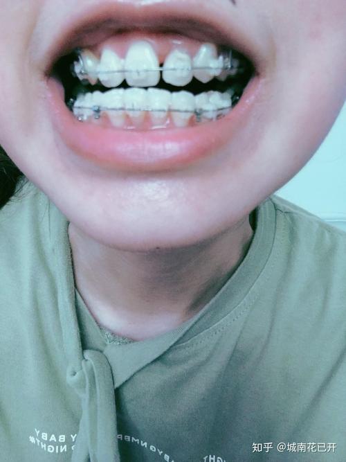 20岁正畸牙齿矫正周期一般是多久？不同牙齿畸形程度会影响治疗时间吗？-图2