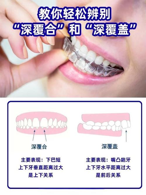 成人深覆盖矫正有哪些有效方法？不同矫正方式的优缺点及适用人群是怎样的？-图3