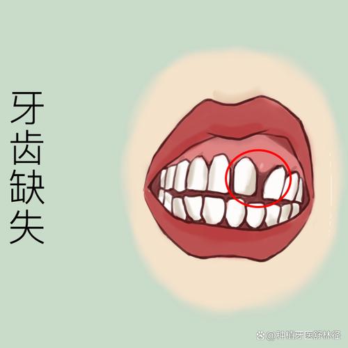 缺牙多年未补牙，现在想种牙还来得及吗？牙槽骨条件差会影响种牙效果吗？-图1