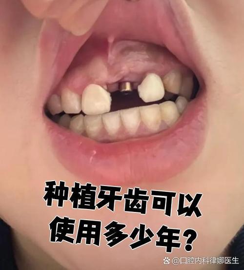 缺牙多年未补牙，现在想种牙还来得及吗？牙槽骨条件差会影响种牙效果吗？-图3