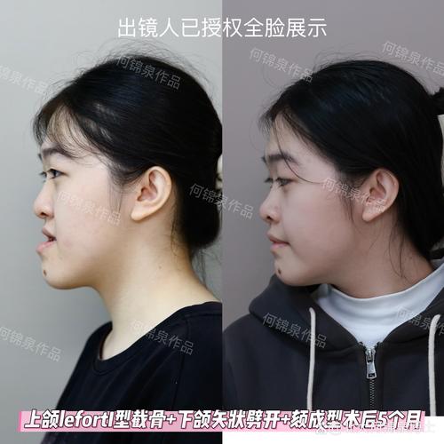 地包天脸型矫正有哪些常用方法?不同矫正方式的效果、风险及适用人群如何科学选择?-图2 地包天脸型矫正有哪些常用方法?不同矫正方式的效果、风险及适用人群如何科学选择?-图2