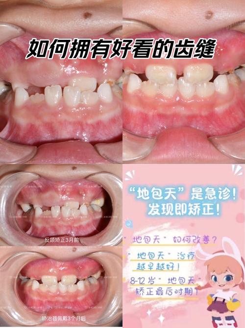 地包天脸型矫正有哪些常用方法?不同矫正方式的效果、风险及适用人群如何科学选择?-图3 地包天脸型矫正有哪些常用方法?不同矫正方式的效果、风险及适用人群如何科学选择?-图3