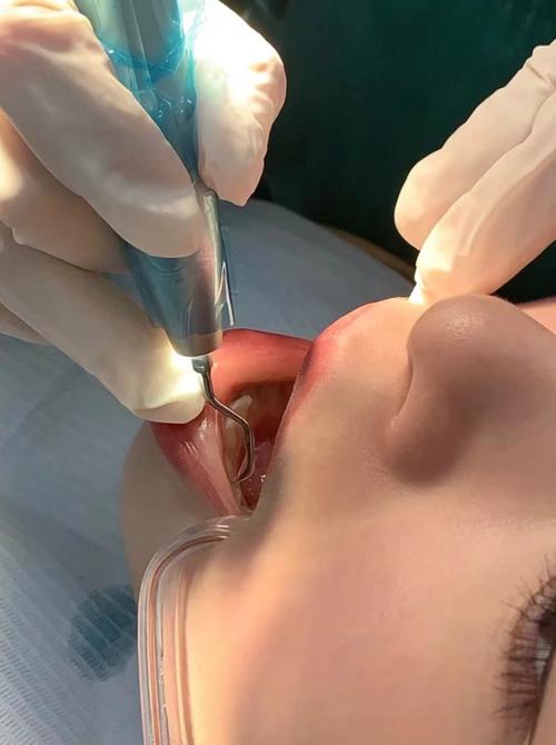 口腔科手机清洗的关键步骤有哪些?不同型号手机的清洗方法有何差异?-图3 口腔科手机清洗的关键步骤有哪些?不同型号手机的清洗方法有何差异?-图3