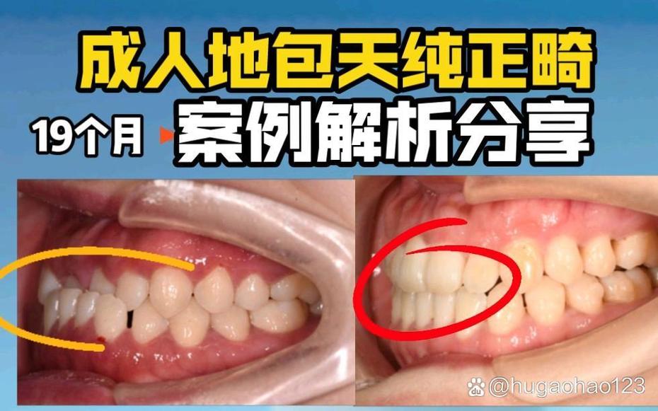 成年地包天矫正方法有哪些?不同矫正方式的优缺点是什么?矫正周期和效果会因人而异吗?-图3 成年地包天矫正方法有哪些?不同矫正方式的优缺点是什么?矫正周期和效果会因人而异吗?-图3