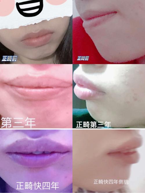 中山附属口腔医院正畸效果如何？不同错颌畸形适合哪些矫正技术？价格和周期大概是多少？-图2