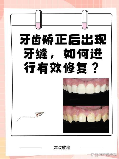 正畸后门牙中间出现牙缝，是矫正失败还是反弹？需要重新矫正吗？-图3