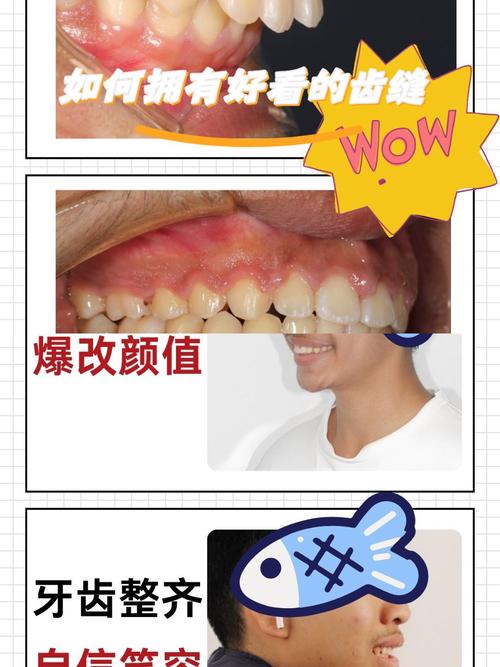 术前正畸阶段牙齿为何会显得更丑?这背后隐藏着怎样的矫正逻辑与必经过程?-图3 术前正畸阶段牙齿为何会显得更丑?这背后隐藏着怎样的矫正逻辑与必经过程?-图3