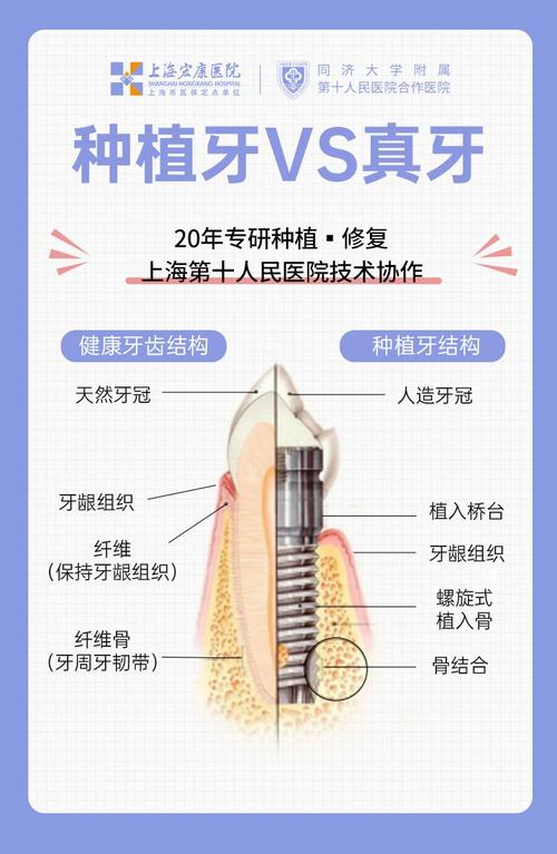 种牙和种植牙究竟哪个说法更准确?两者在专业定义、手术方式及效果上存在哪些差异?-图1 种牙和种植牙究竟哪个说法更准确?两者在专业定义、手术方式及效果上存在哪些差异?-图1