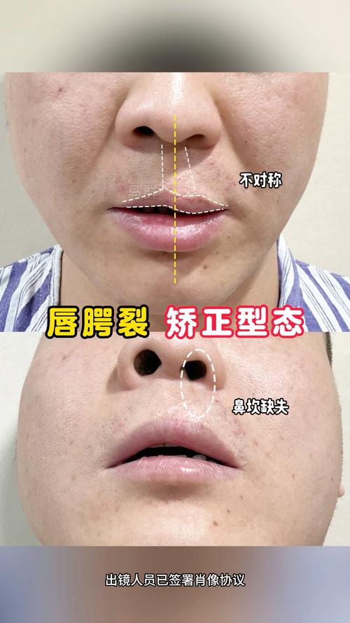 唇腭裂患者正畸序列治疗如何分阶段干预以优化咬合功能与面部美观？-图3