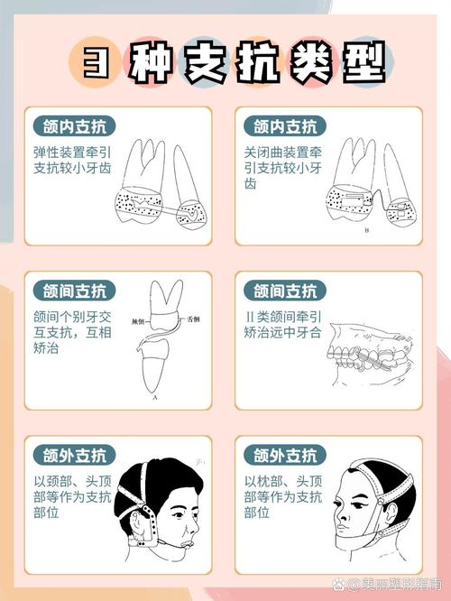 正畸治疗中支抗究竟如何决定牙齿移动方向？其作用机制对治疗效果稳定性有何关键影响？-图1