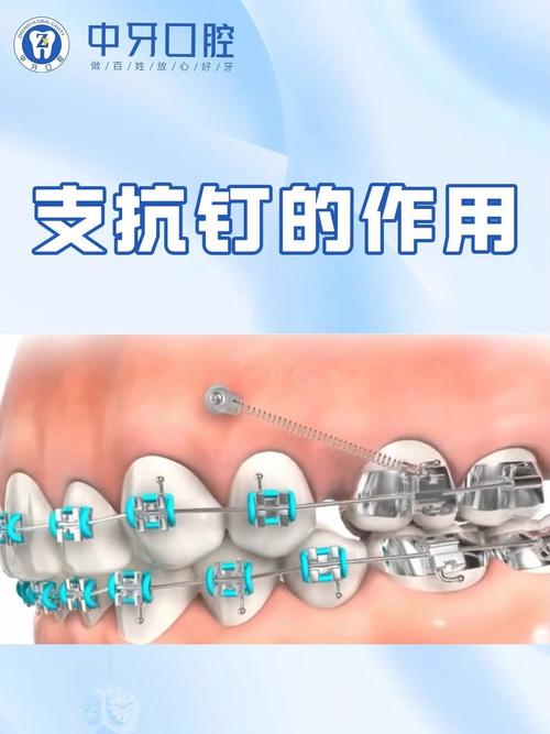 正畸治疗中支抗究竟如何决定牙齿移动方向？其作用机制对治疗效果稳定性有何关键影响？-图3