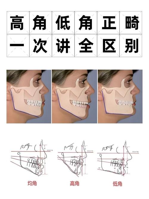 Z角作为正畸测量数据的关键指标,其在面部美学分析与治疗方案设计中究竟具有哪些核心临床意义?-图3 Z角作为正畸测量数据的关键指标,其在面部美学分析与治疗方案设计中究竟具有哪些核心临床意义?-图3