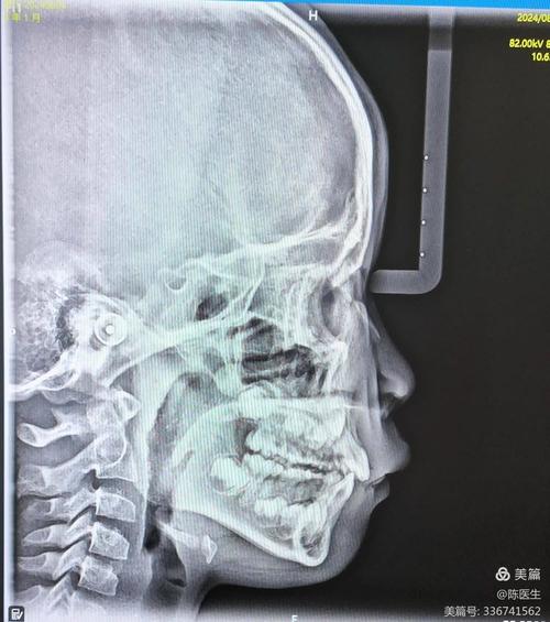 正畸诊断中X线检查为何不可或缺?不同类型X线片如何辅助分析牙齿、颌骨及咬合关系的异常?-图1 正畸诊断中X线检查为何不可或缺?不同类型X线片如何辅助分析牙齿、颌骨及咬合关系的异常?-图1