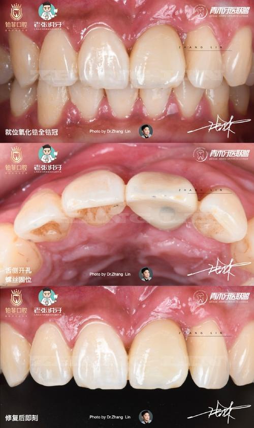 牙槽骨骨吸收会影响种牙吗？骨吸收后还能成功种牙吗？需要做哪些骨修复准备才能种牙？-图1