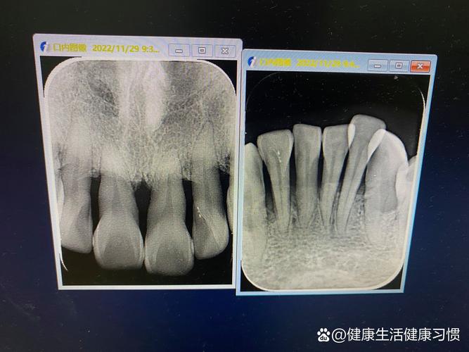 牙槽骨骨吸收会影响种牙吗？骨吸收后还能成功种牙吗？需要做哪些骨修复准备才能种牙？-图2