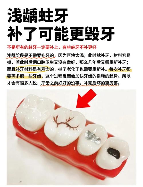 治虫牙最有效的方法究竟是什么?不同严重程度的虫牙该如何选择最佳治疗方案?-图1 治虫牙最有效的方法究竟是什么?不同严重程度的虫牙该如何选择最佳治疗方案?-图1