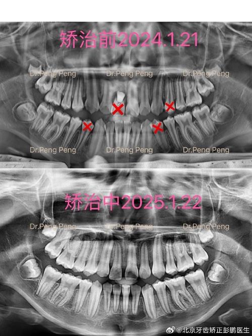 正畸压低前牙为何会导致牙根吸收？其发生机制、危险因素及临床干预策略是什么？-图1