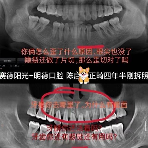 正畸压低前牙为何会导致牙根吸收？其发生机制、危险因素及临床干预策略是什么？-图3