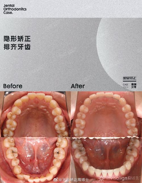 隐形正畸如何精准重建颌面？对不同颌面畸形的效果差异与适用人群有哪些？-图3