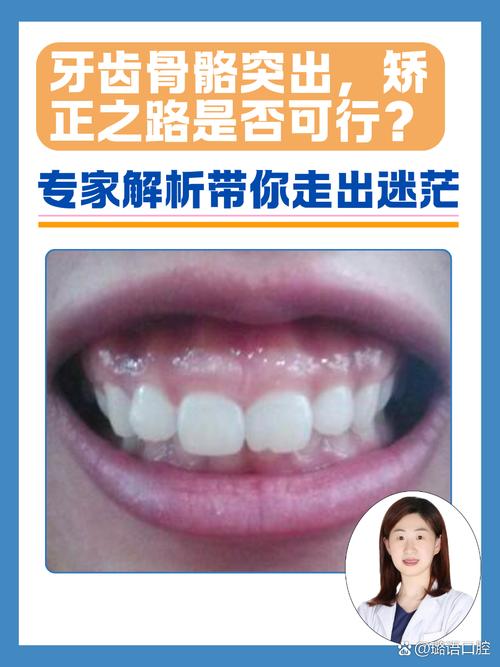 颌骨生长方向异常时,牙齿正畸治疗如何通过骨骼改建实现咬合功能与面部美观的协同重建?-图3 颌骨生长方向异常时,牙齿正畸治疗如何通过骨骼改建实现咬合功能与面部美观的协同重建?-图3