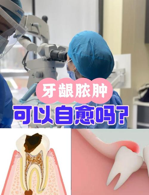 牙龈脓肿的治疗方法有哪些？不同严重程度的治疗方案有何区别？是否需要联合药物与手术干预？家庭护理如何辅助缓解症状？-图3