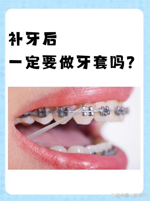 蛀牙数量较多的情况下,还能顺利开展正畸治疗吗?治疗前是否需要先处理蛀牙问题?-图2 蛀牙数量较多的情况下,还能顺利开展正畸治疗吗?治疗前是否需要先处理蛀牙问题?-图2