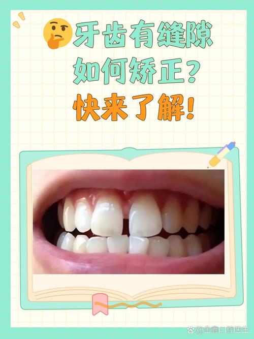 正畸可以让牙缝变小吗-图1 正畸可以让牙缝变小吗-图1