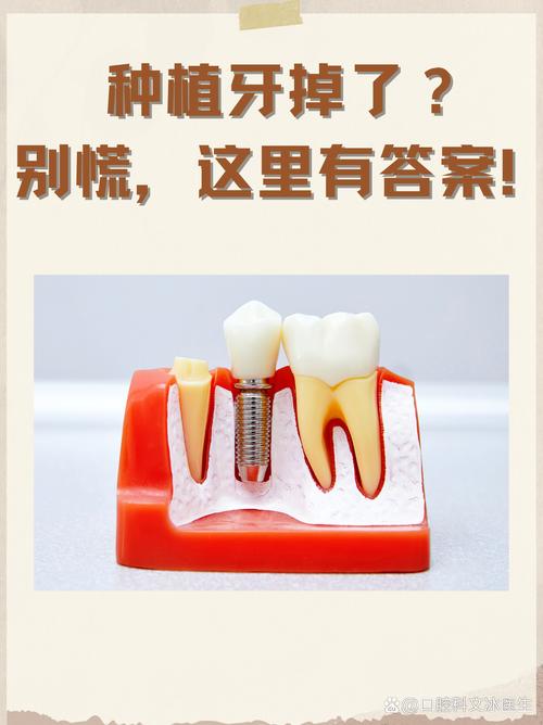 牙医自己牙齿掉了，会优先选择种植牙吗？背后藏着哪些专业考量？-图2