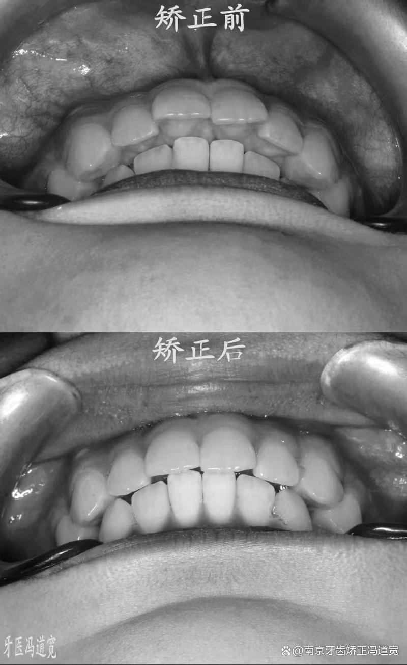 南京第一医院口腔正畸效果如何?医生技术好不好?价格贵不贵?适合哪些牙齿问题呢?-图3 南京第一医院口腔正畸效果如何?医生技术好不好?价格贵不贵?适合哪些牙齿问题呢?-图3