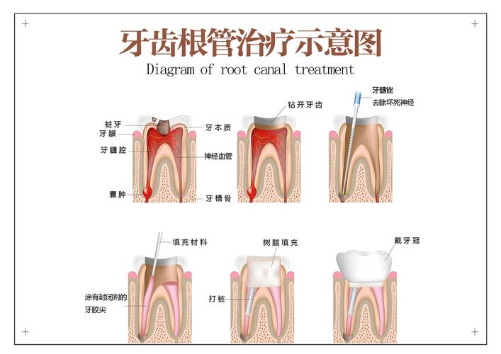 根尖周炎的治疗方法有哪些?不同治疗方式的适用情况、疗效及如何选择最适合自己的方案?-图1 根尖周炎的治疗方法有哪些?不同治疗方式的适用情况、疗效及如何选择最适合自己的方案?-图1