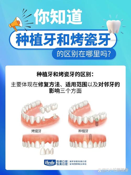 种牙和全瓷牙到底怎么选？从适用人群、优缺点到价格全面对比，哪种更适合你的牙齿状况？-图2