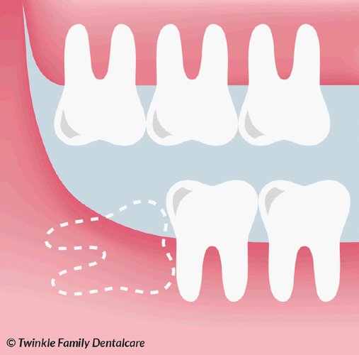 畸形牙的治疗方法有哪些？不同畸形类型该如何选择最佳方案？治疗周期和效果如何保障？-图1