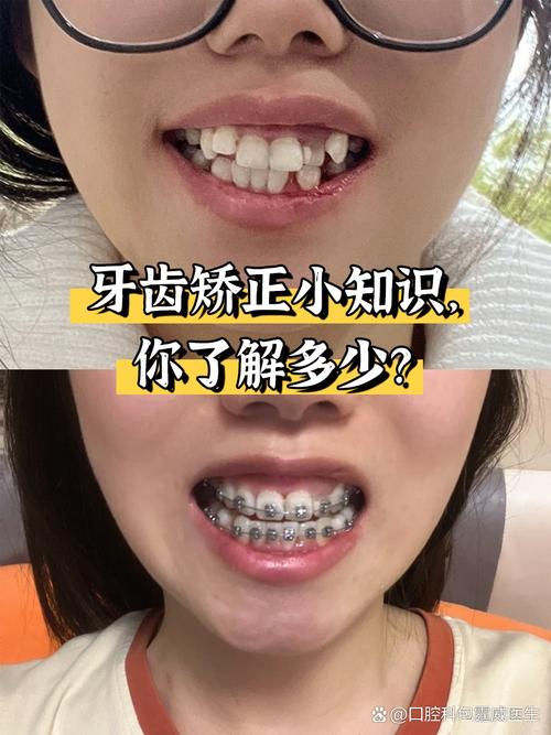 矫正牙齿有哪些常见方法?不同方法的优缺点、适用人群及选择标准是什么?-图3 矫正牙齿有哪些常见方法?不同方法的优缺点、适用人群及选择标准是什么?-图3