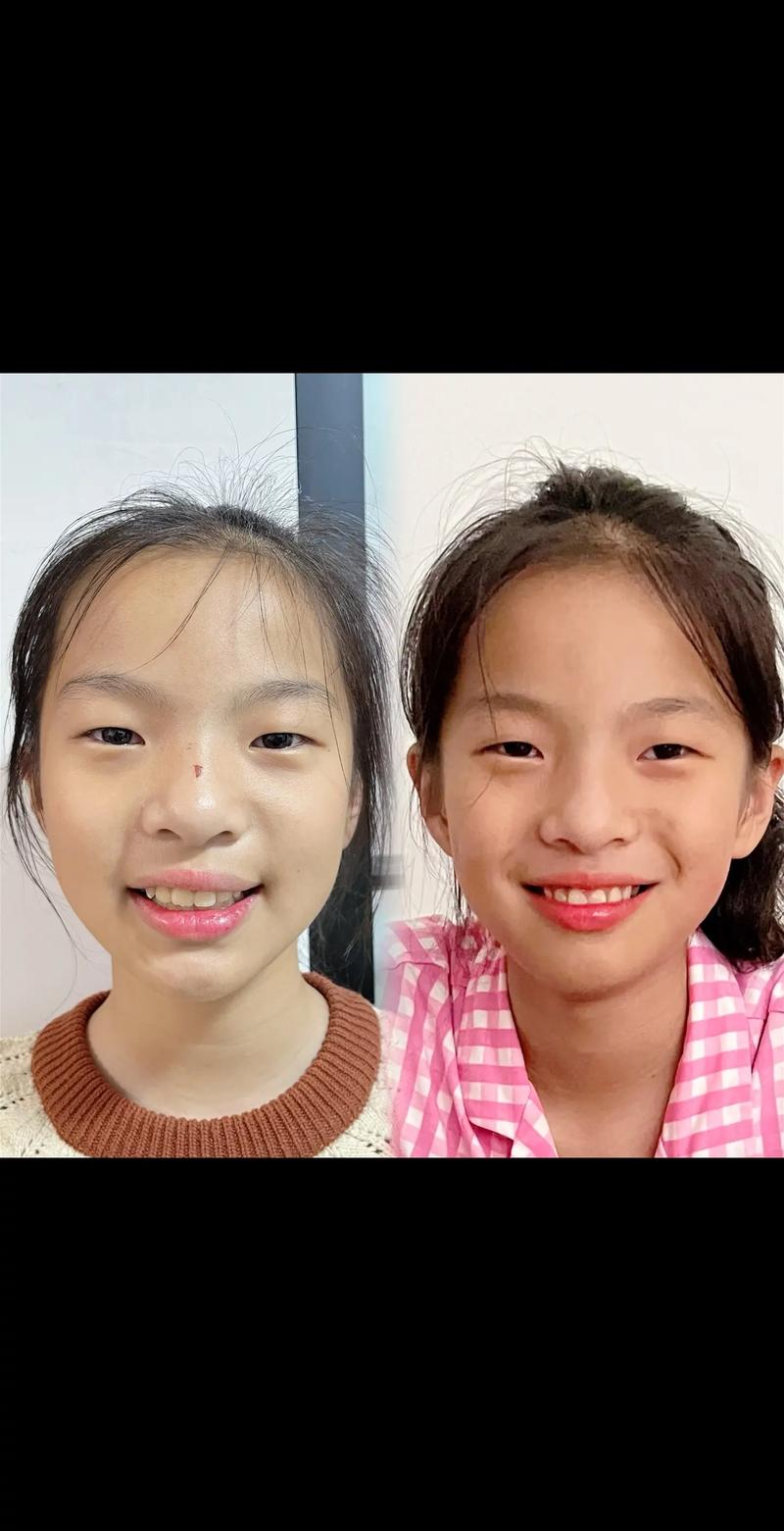 小孩反合(地包天)正畸前后图片对比能看出哪些牙齿变化?正畸过程中家长需要注意哪些关键问题?-图1 小孩反合(地包天)正畸前后图片对比能看出哪些牙齿变化?正畸过程中家长需要注意哪些关键问题?-图1