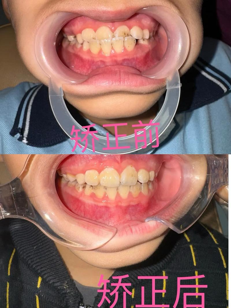 小孩反合（地包天）正畸前后图片对比能看出哪些牙齿变化？正畸过程中家长需要注意哪些关键问题？-图3