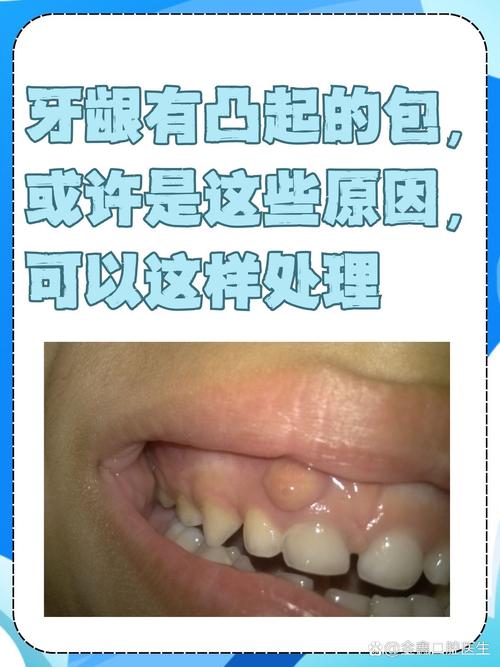 正畸牙齿矫正为何会引发牙龈增生?背后原因、影响及应对方法有哪些?-图1 正畸牙齿矫正为何会引发牙龈增生?背后原因、影响及应对方法有哪些?-图1