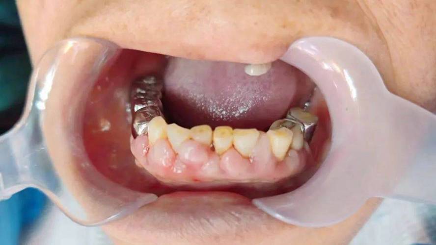 正畸牙齿矫正为何会引发牙龈增生？背后原因、影响及应对方法有哪些？-图3