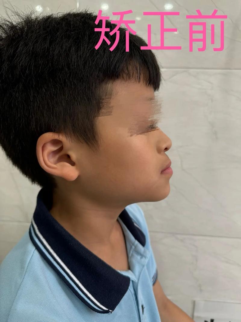 正畸富士0去除的正确方法是什么?操作时需注意哪些事项以避免牙齿损伤?-图3 正畸富士0去除的正确方法是什么?操作时需注意哪些事项以避免牙齿损伤?-图3