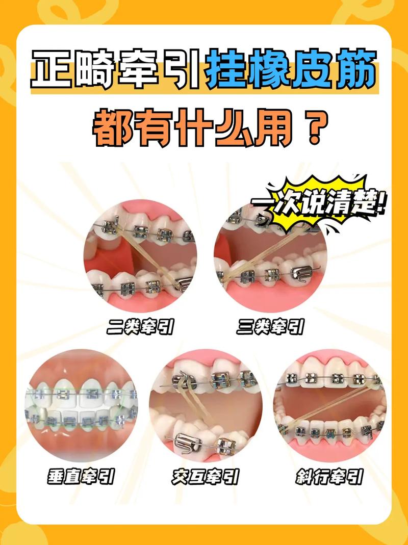 正畸治疗中中线偏斜如何精准矫正?不同调整方法的适用场景与临床效果差异解析-图3 正畸治疗中中线偏斜如何精准矫正?不同调整方法的适用场景与临床效果差异解析-图3