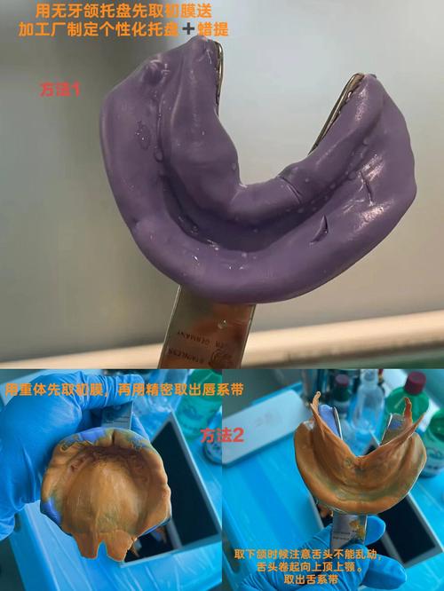 在精密附件修复中，如何选择合适的取模方法以确保印模精度和边缘适合性？-图1