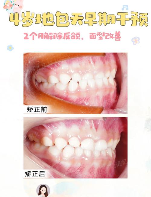 正畸治疗地包天具体有哪些方法?效果如何?有没有年龄限制?一般需要多长时间?-图2 正畸治疗地包天具体有哪些方法?效果如何?有没有年龄限制?一般需要多长时间?-图2