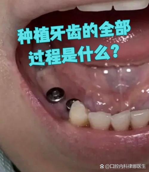 种牙第二手术到底疼不疼？过程痛感能忍受吗？术后恢复期会有哪些不适？-图1